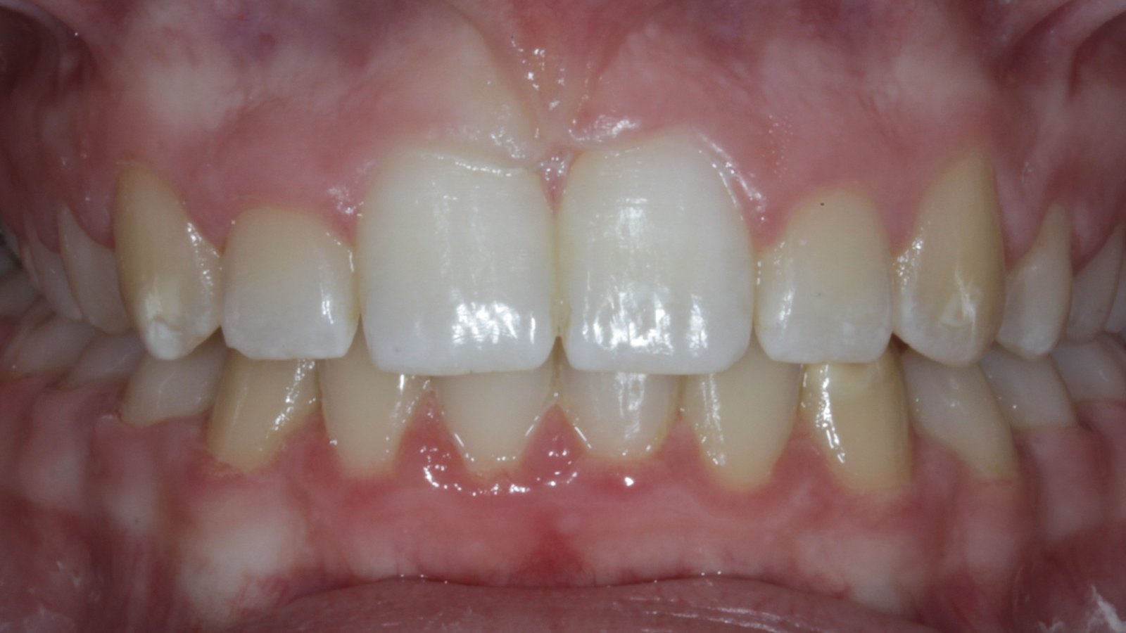 Case 03 smile after orthodontic treatment