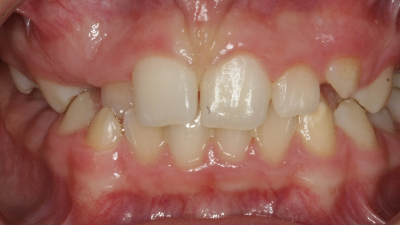 Case 03 smile before orthodontic treatment
