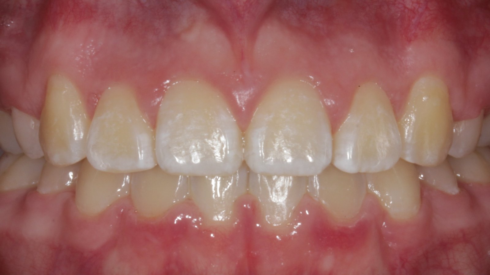Case 10 smile after orthodontic treatment