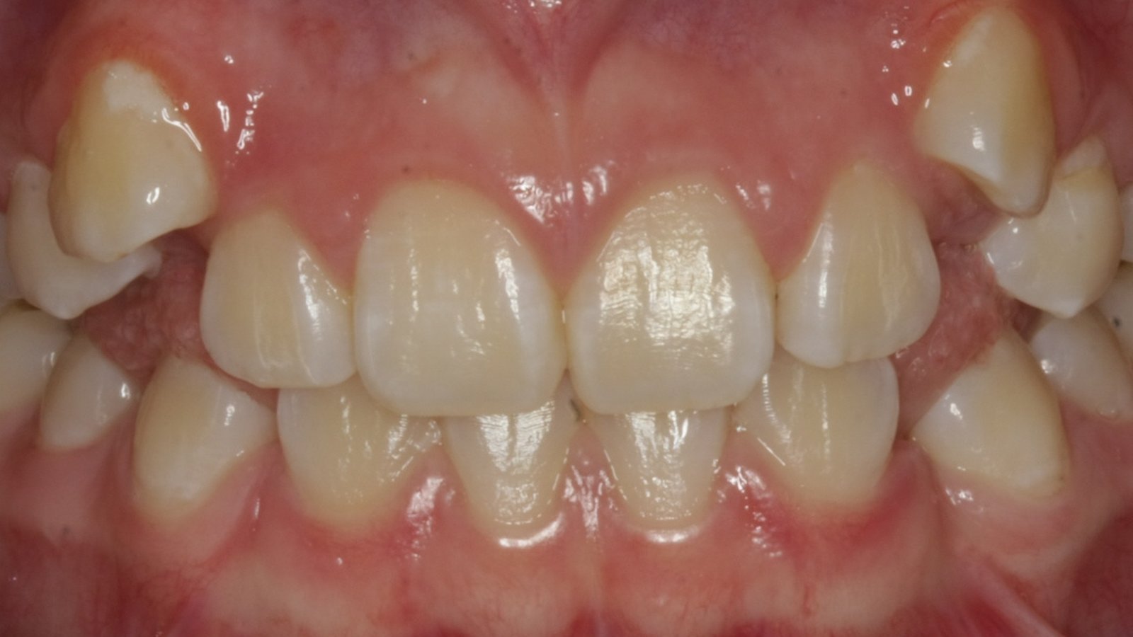 Case 10 smile before orthodontic treatment