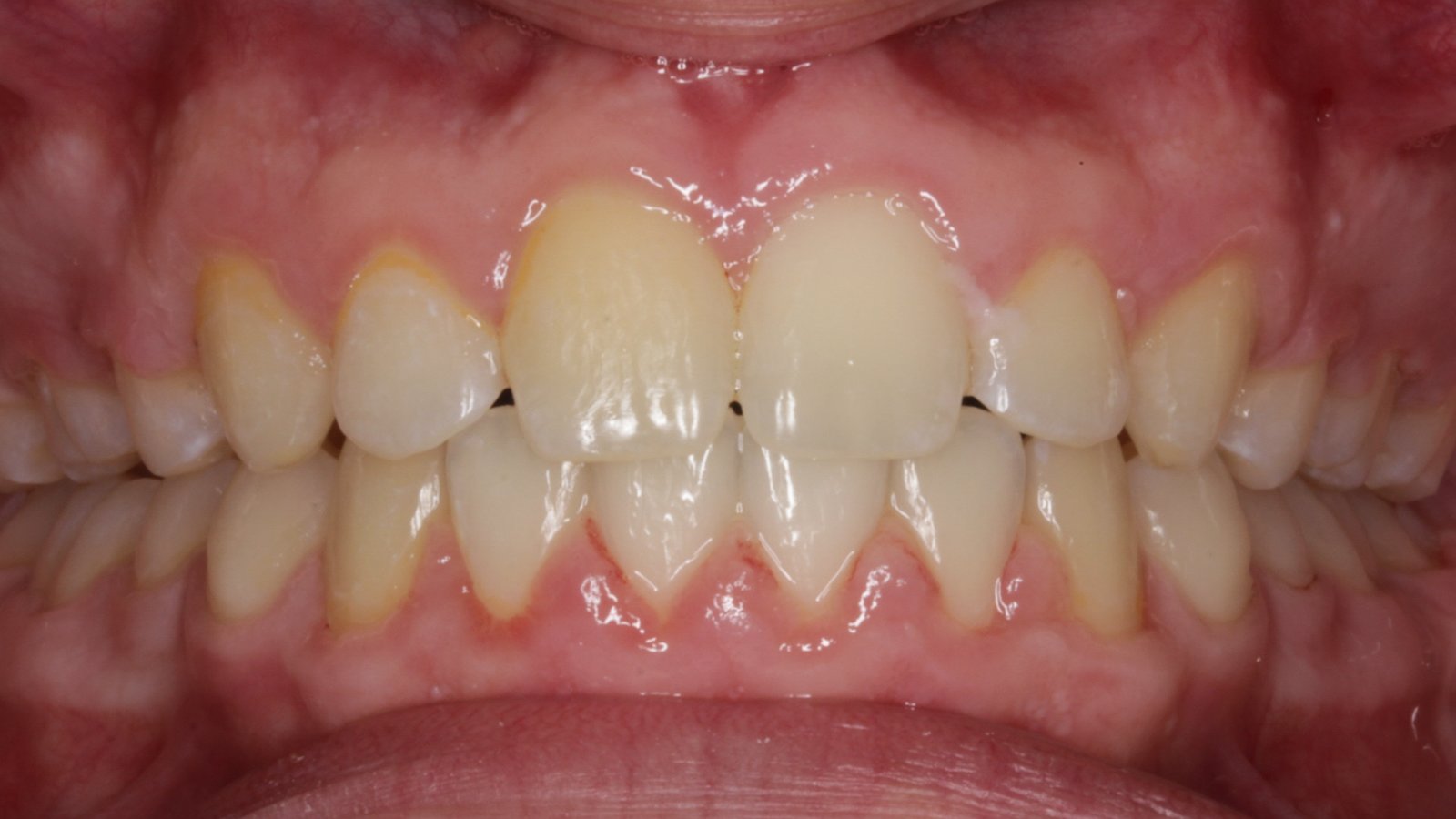 Case 11 smile after orthodontic treatment