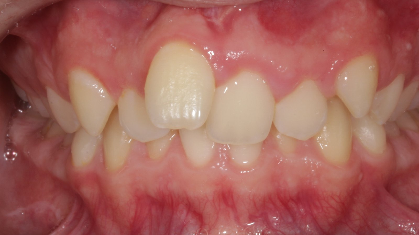 Case 11 smile before orthodontic treatment