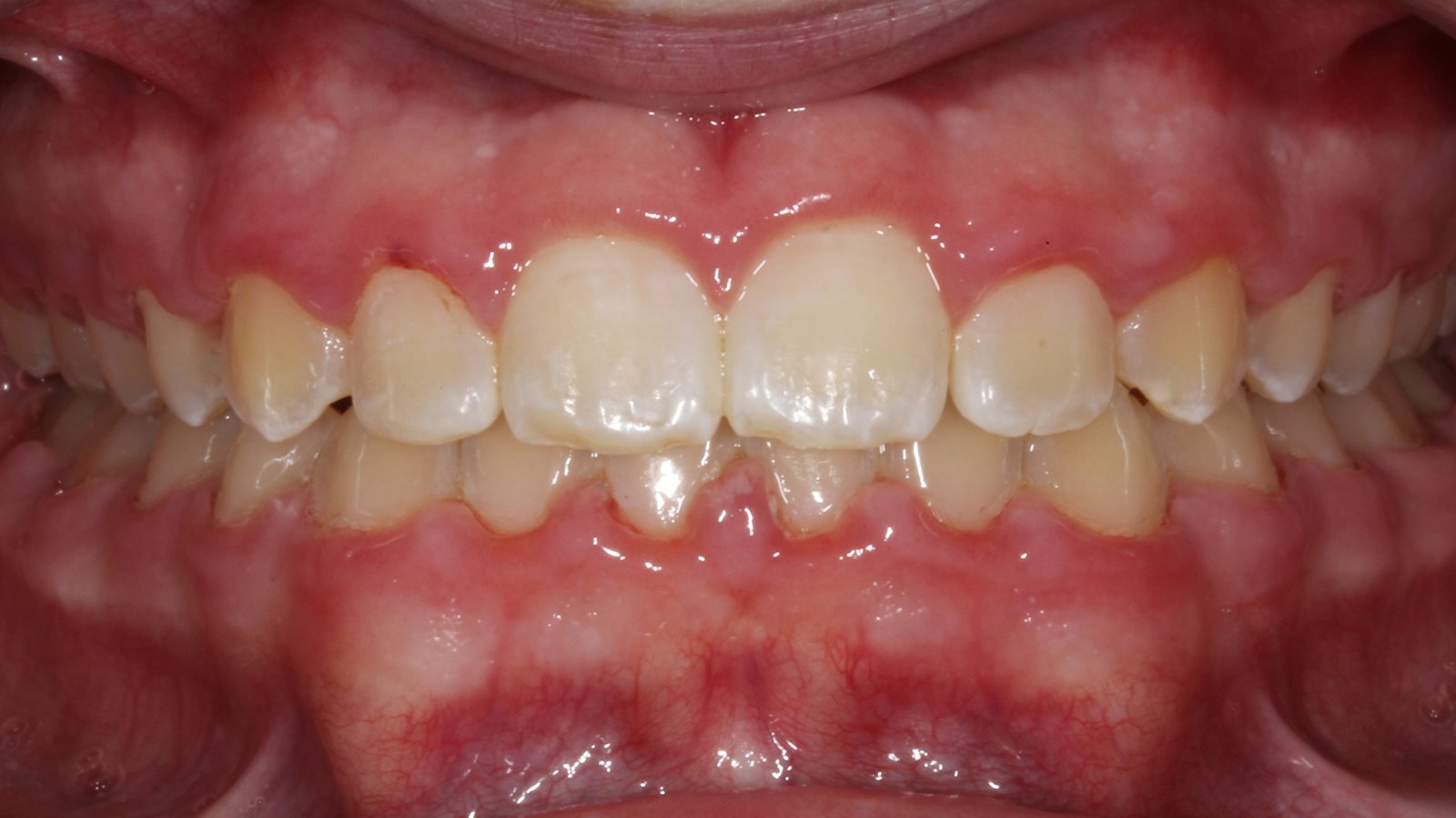 Case 19 smile after orthodontic treatment