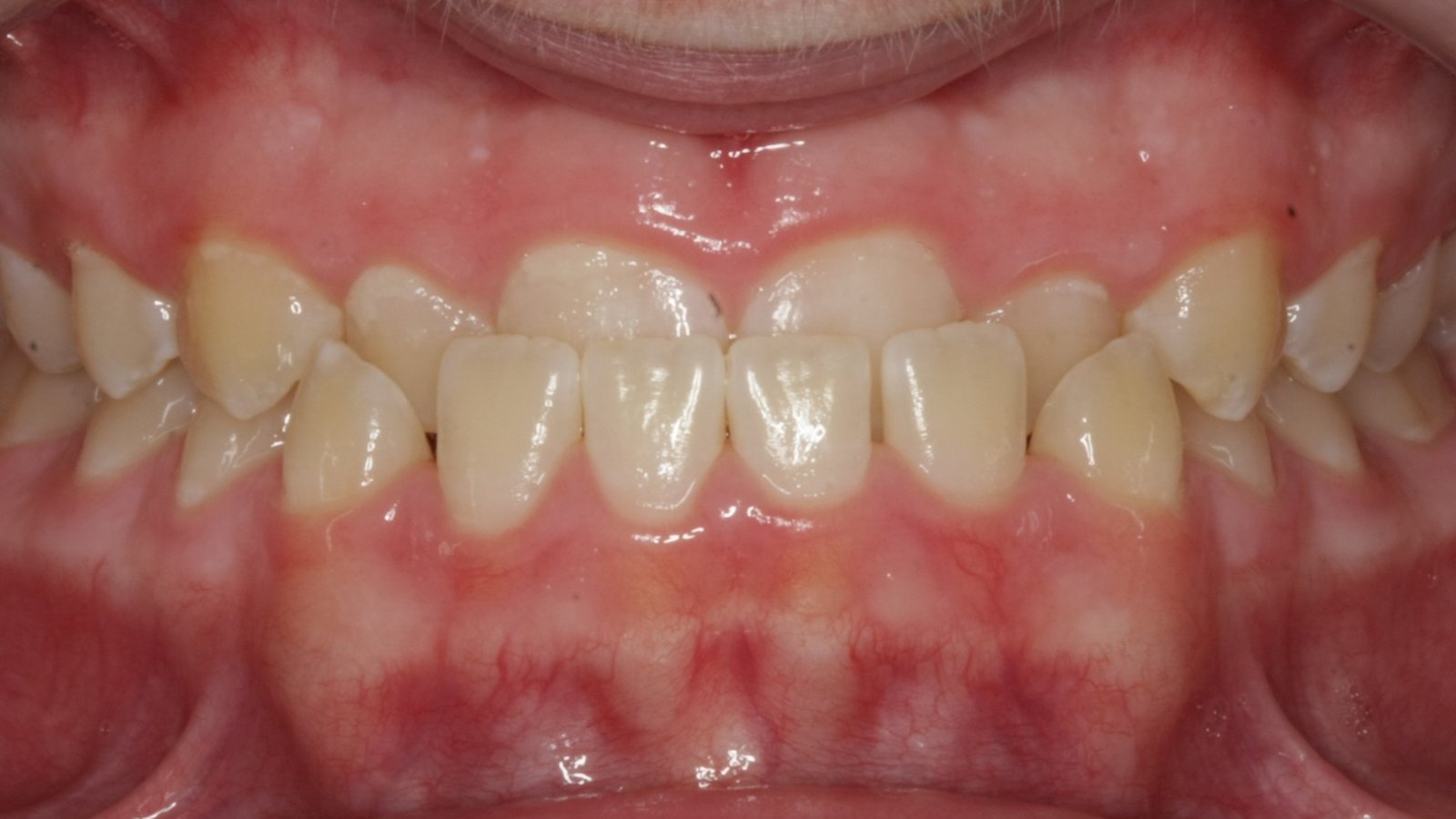 Case 19 smile before orthodontic treatment