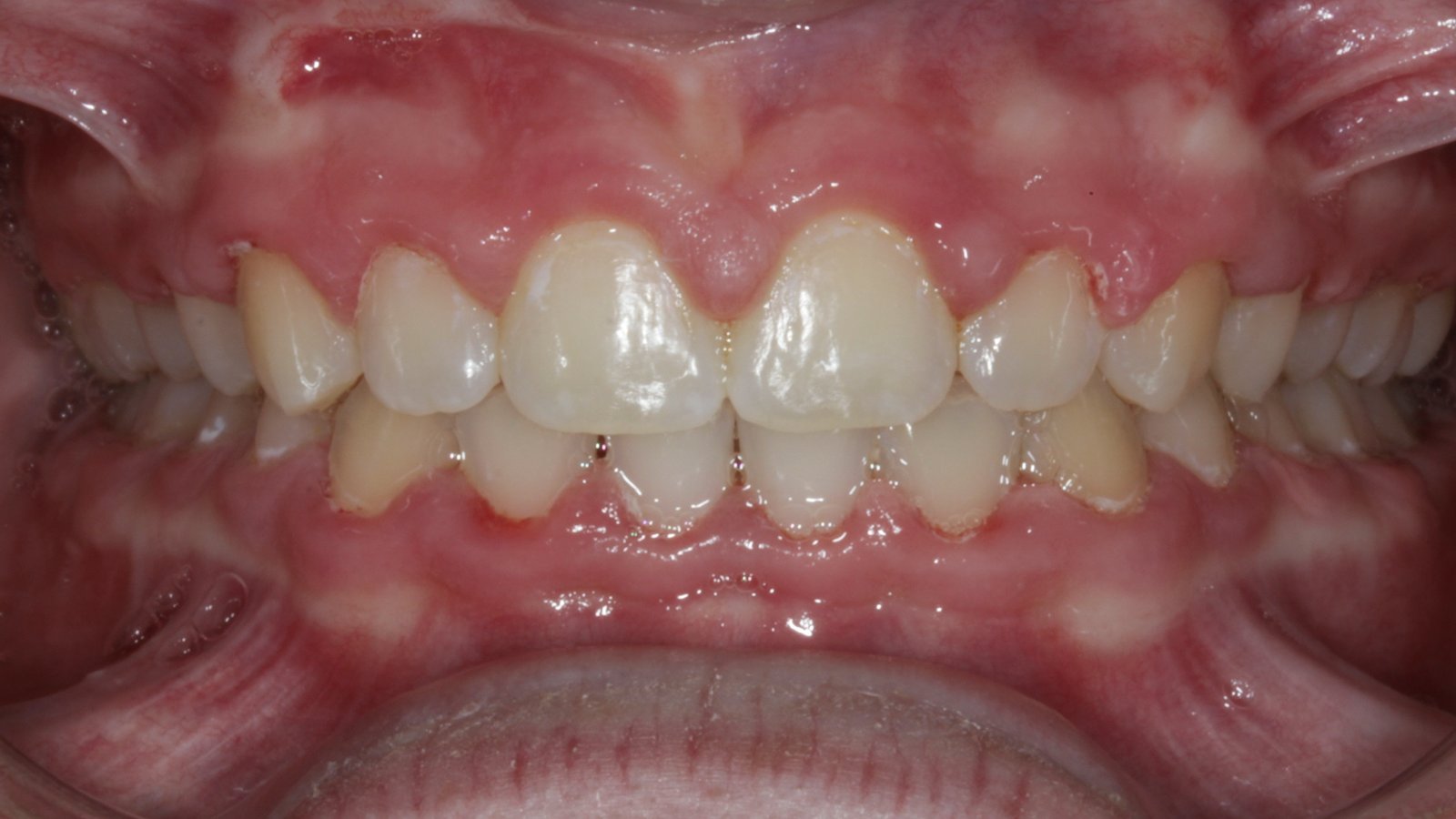 Case 20 smile after orthodontic treatment