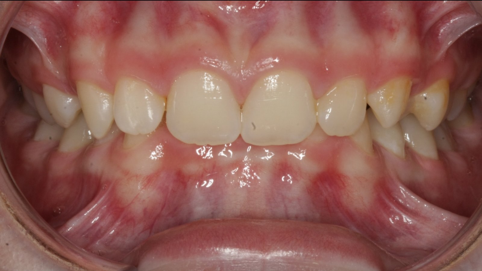 Case 20 smile before orthodontic treatment