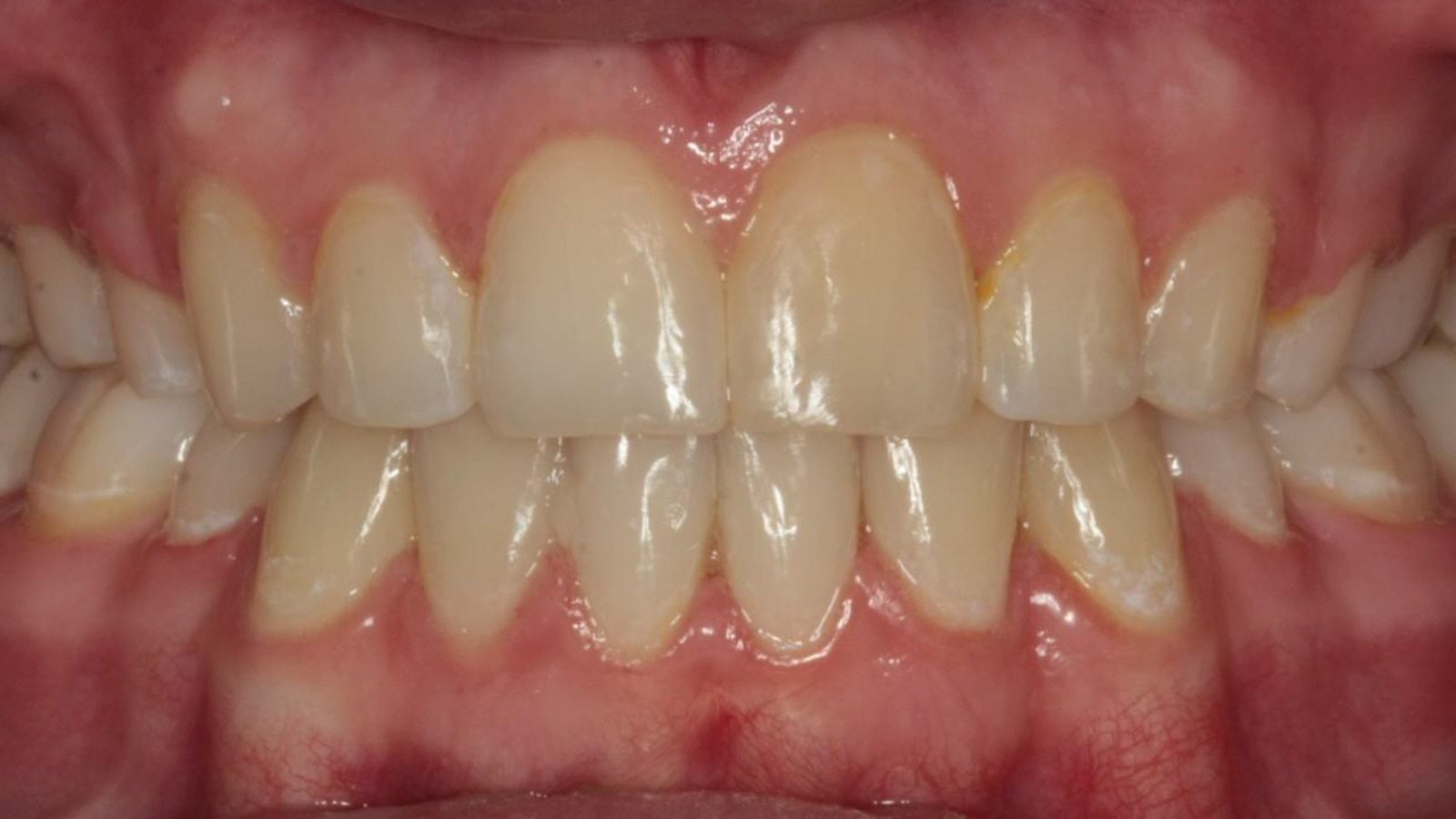 Case 22 smile after orthodontic treatment