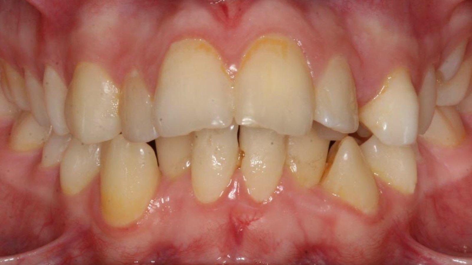 Case 22 smile before orthodontic treatment