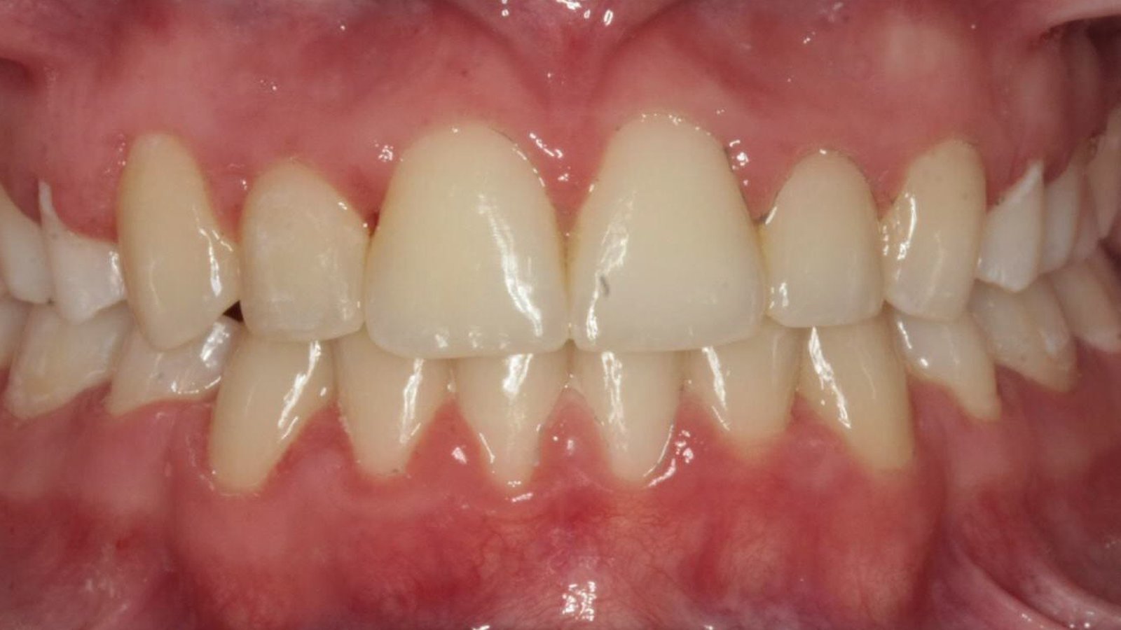 Case 25 smile after orthodontic treatment