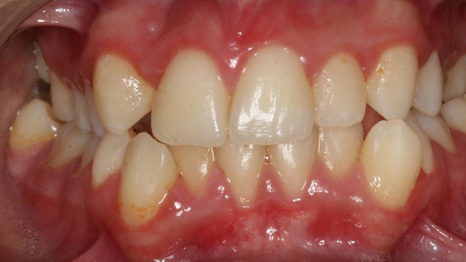 Case 25 smile before orthodontic treatment